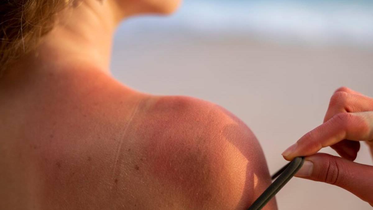 Cómo saber si tienes alergia al sol y qué hacer para prevenir su aparición