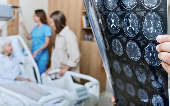 El ictus es la segunda causa de muerte en el mundo.