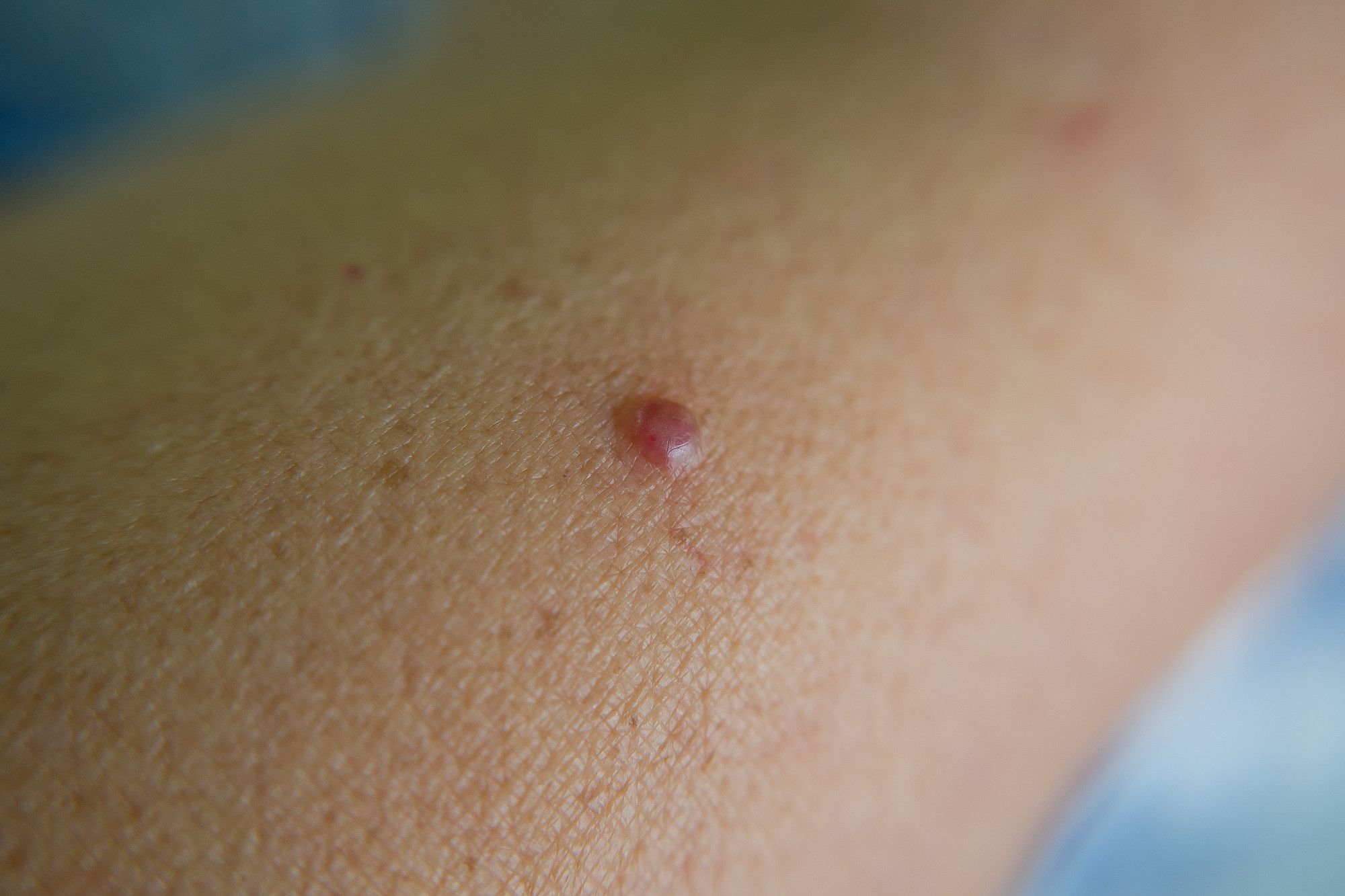 Un punto rubí, también llamado angioma capilar adquirido, en un brazo.