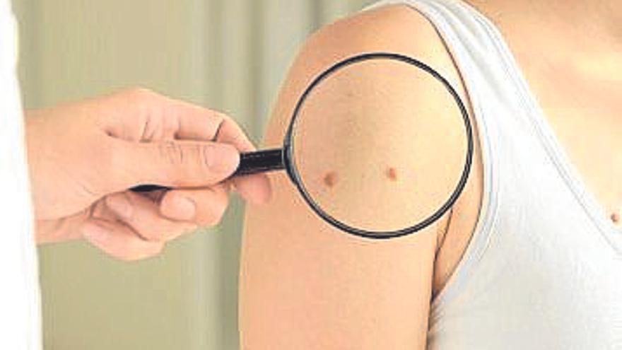 Melanoma