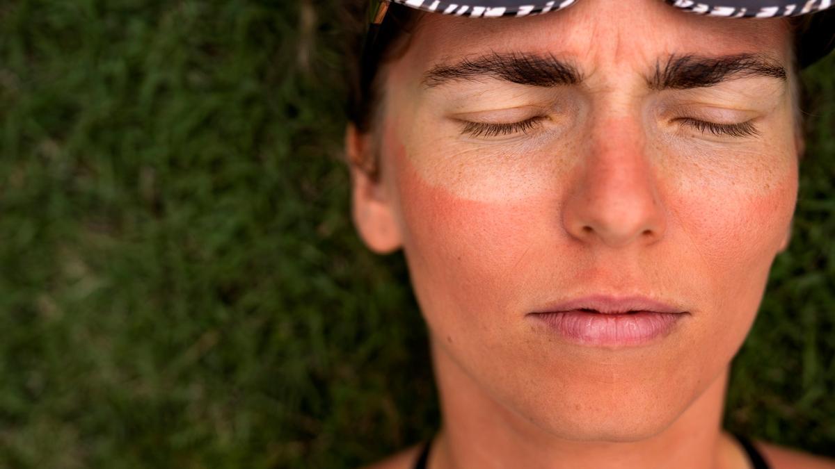 La quemadura solar en la cara ha dejado la marca de las gafas de sol alrededor de los ojos.
