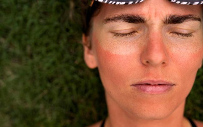 La quemadura solar en la cara ha dejado la marca de las gafas de sol alrededor de los ojos. / Freepik La quemadura solar en la cara ha dejado la marca de las gafas de sol alrededor de los ojos.