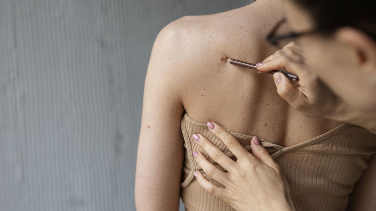 Hay que acudir al dermatólogo ante la aparición de lesiones nuevas o cambios en lunares pre-existentes.