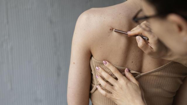 Hay que acudir al dermatólogo ante la aparición de lesiones nuevas o cambios en lunares pre-existentes.