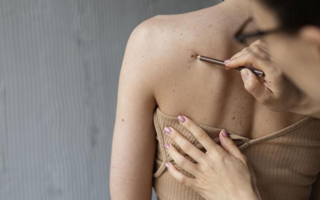 Hay que acudir al dermatólogo ante la aparición de lesiones nuevas o cambios en lunares pre-existentes.