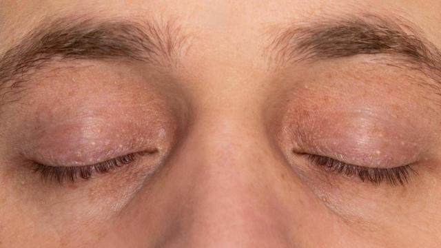 Los milium son pequeñas acumulaciones de queratina bajo la piel.