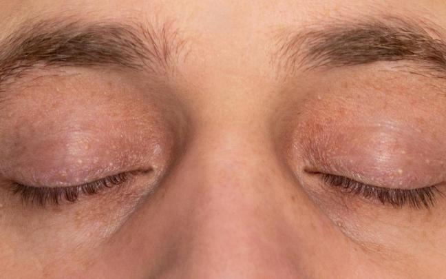 Los milium son pequeñas acumulaciones de queratina bajo la piel.