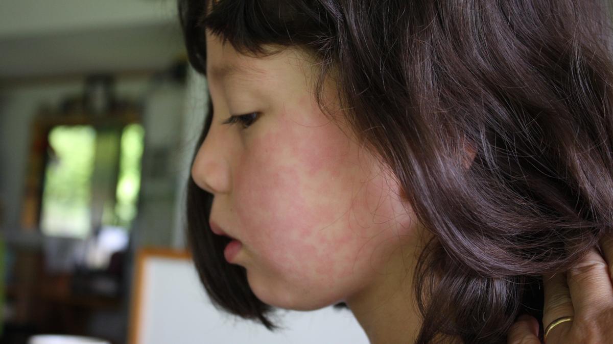 Una niña, con una erupción en la cara tras contagiarse de parvovirus. Foto: Timothy Takemoto