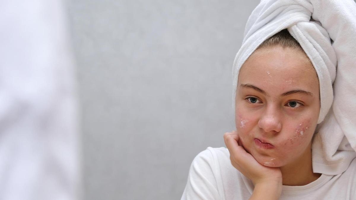 Una adolescente con acné en el rostro tuerce el gesto.