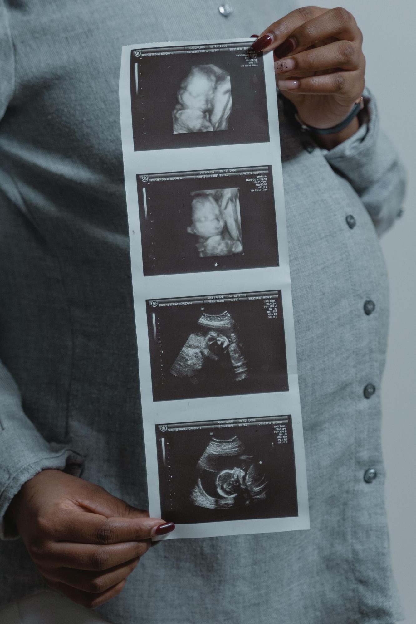 La madre ha dado a luz a cuatrillizas monocigóticas, un caso que los especialistas consideran extraordinario.