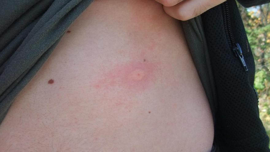 Picadura de avispa.