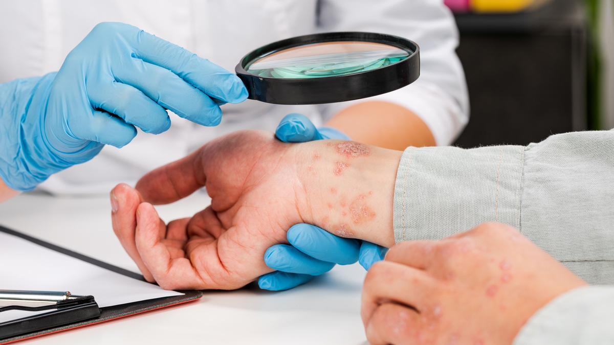 El futuro de la psoriasis podría estar marcado por el empleo de terapias avanzadas.