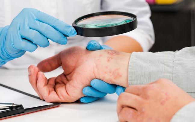 El futuro de la psoriasis podría estar marcado por el empleo de terapias avanzadas.