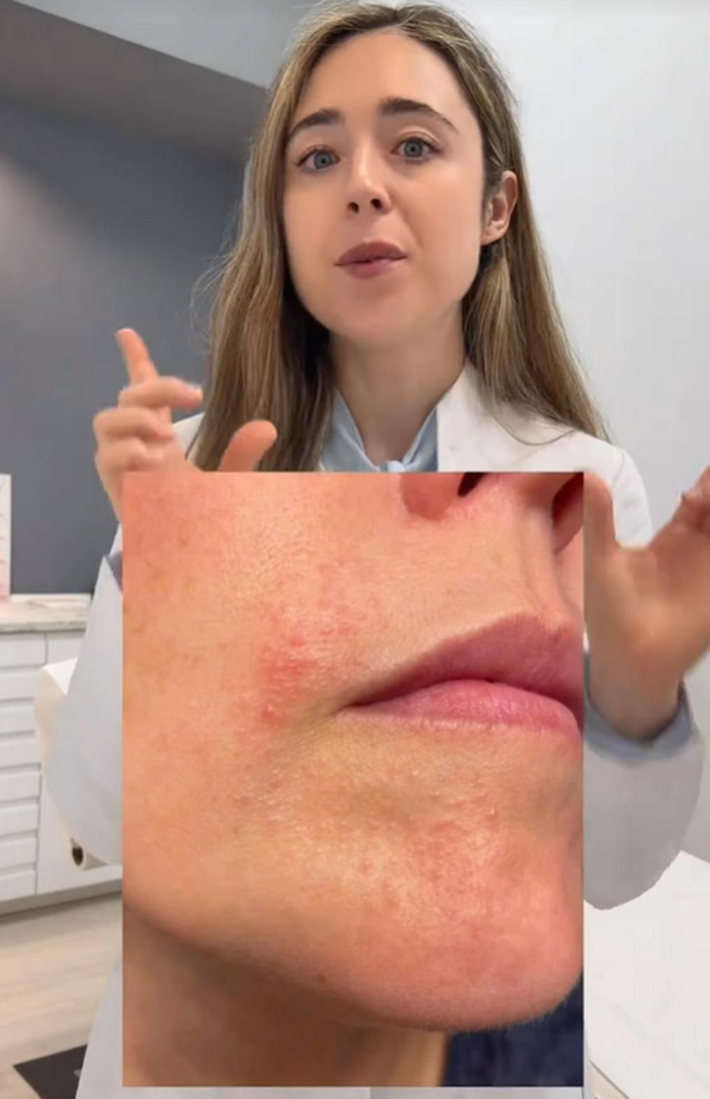 La dermatitis perioral es muy frecuente, pero distinta a otros trastornos más populares como pueden ser el acné o la rosácea.