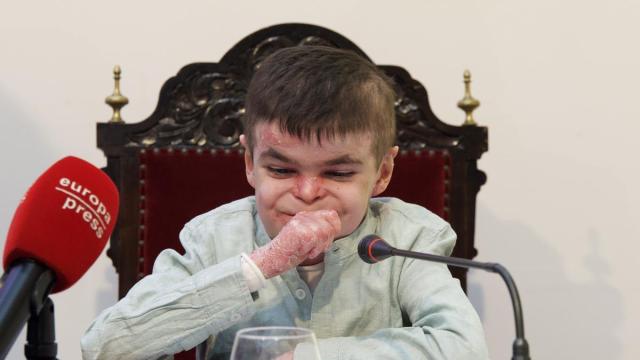 El pequeño Leo, que sufre la enfermedad ‘piel de mariposa'.
