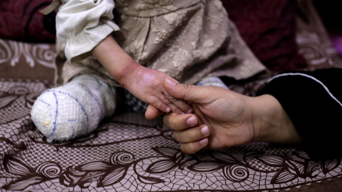 Un niño amputado en el Hospital Mártires de Al Aqsa, en la ciudad de Deir al Balá, a causa de la ofensiva lanzada por Israel contra la Franja de Gaza tras los ataques del 7 de octubre de 2023