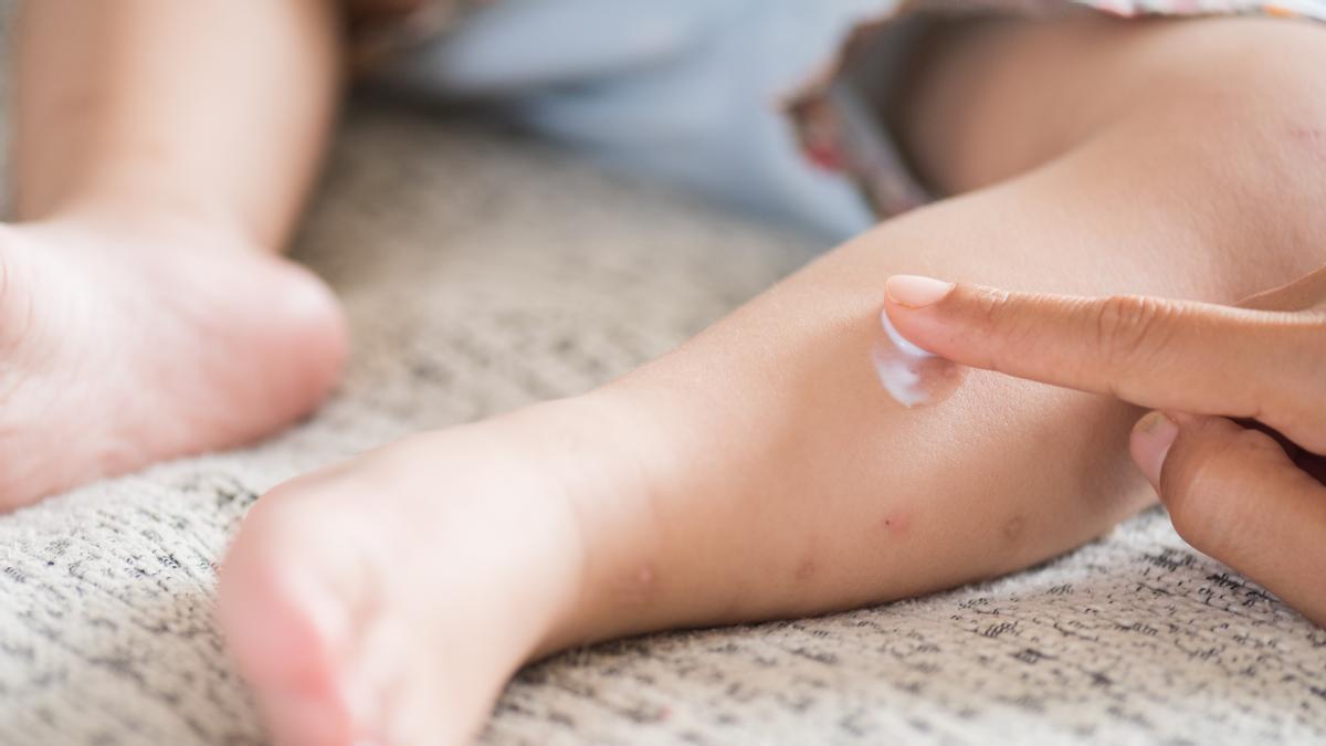 Madre aplica una crema a su hija por la picadura de un insecto.