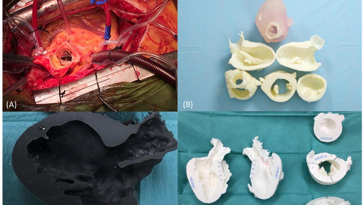 Modelos cardíacos impresos en 3D por la unidad de Cruces para planificar intervenciones de miocardiopatía hipertrófica obstructiva.