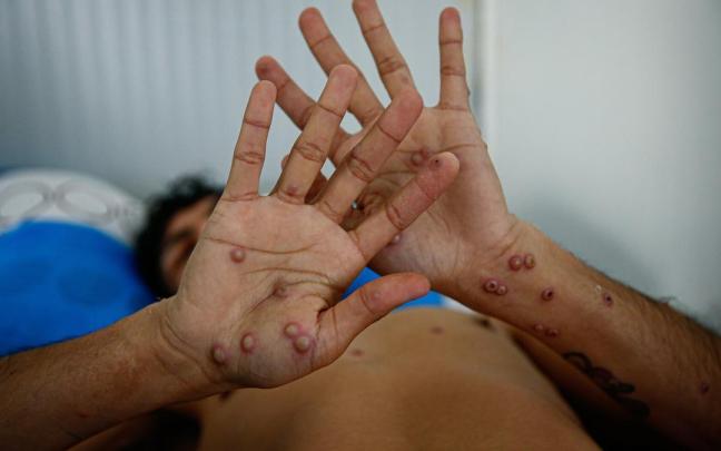 Persona infectada con la viruela del mono.