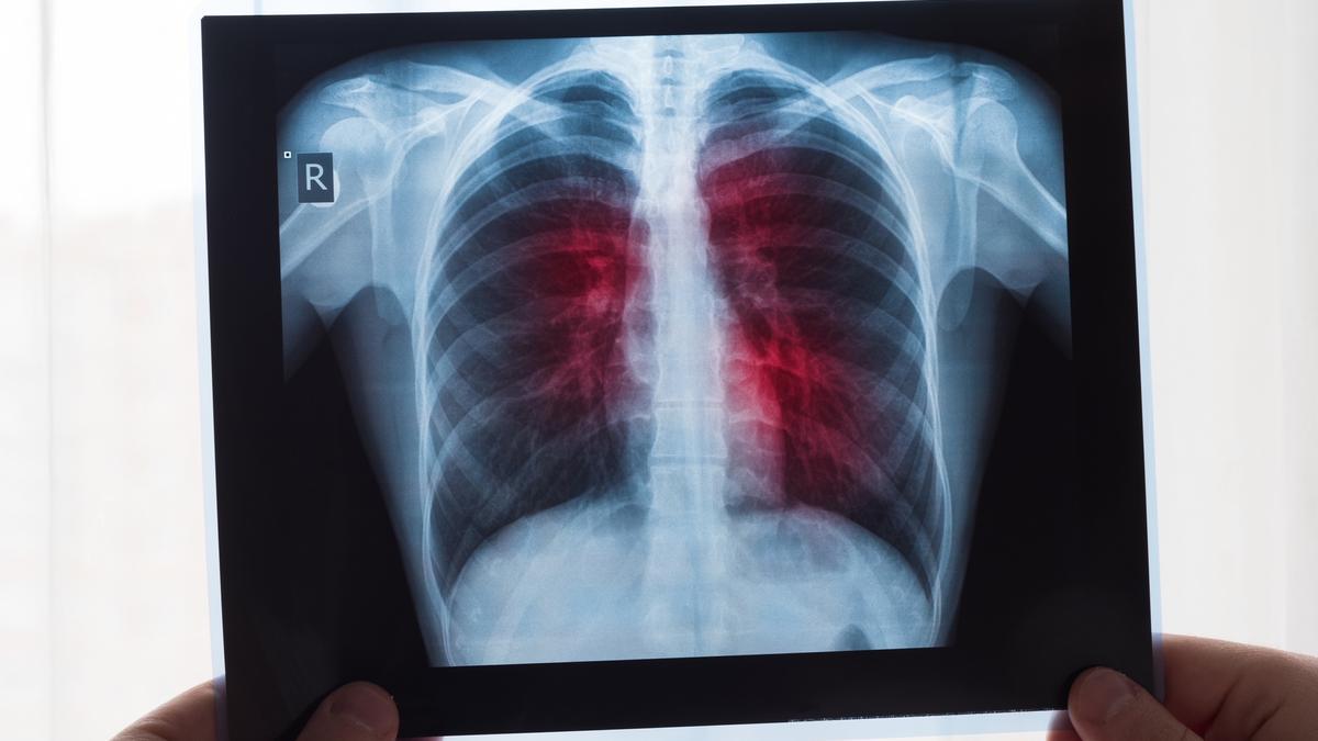 Radiografía de unos pulmones