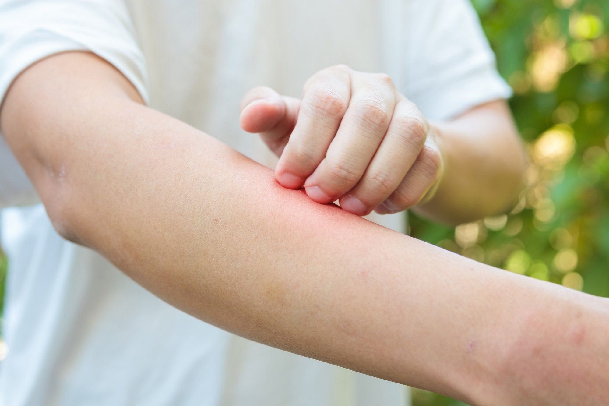 Un hombre se rasca el brazo tras sufrir una picadura.
