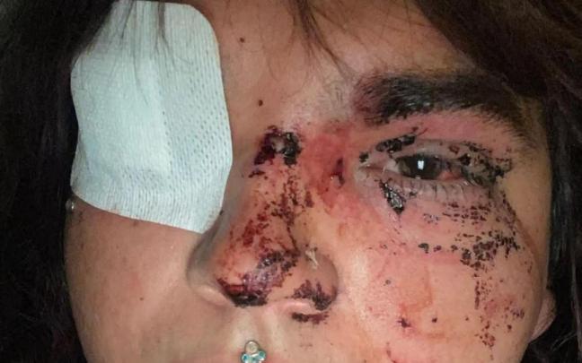 Bianca Fernández, tras la agresión.