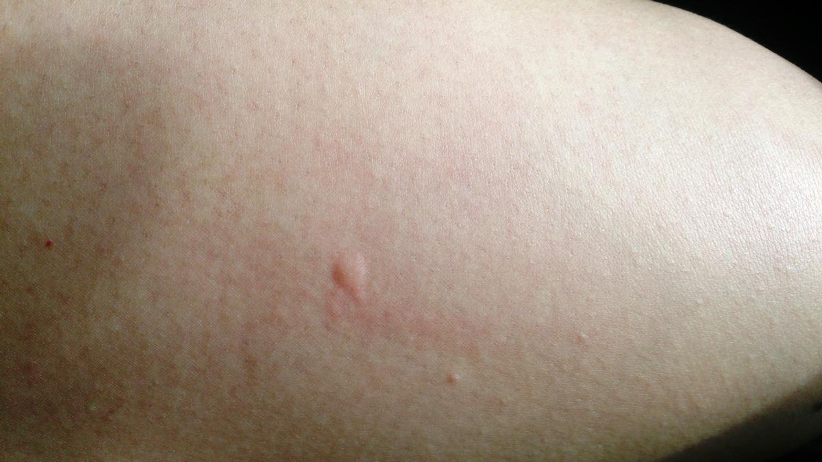 Picadura de mosquito.