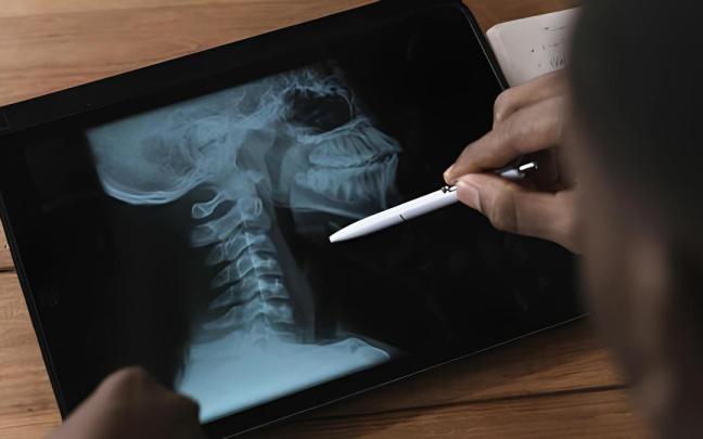 La Universidad de Deusto participa en una IA que predice la calidad de vida de supervivientes de cáncer de cabeza y cuello.