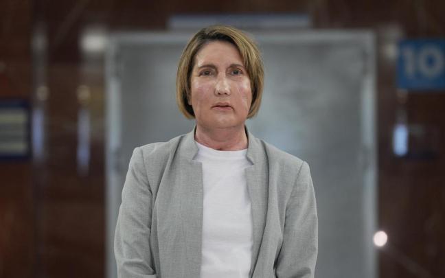 Carme, primera persona en el mundo a la que se realiza un trasplante de cara a partir de una donante que recibió la eutanasia.