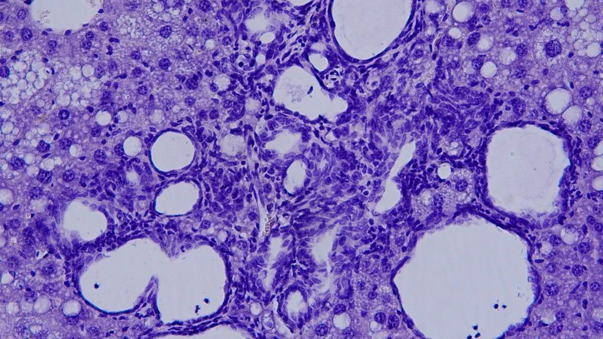 Una muestra del colangiocarcinoma visto al microscopio.