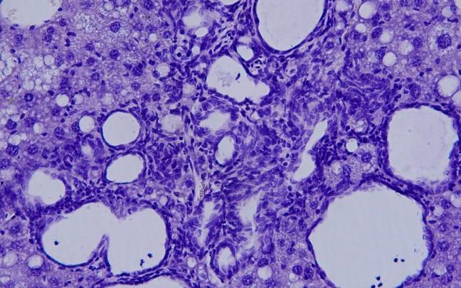 Una muestra del colangiocarcinoma visto al microscopio.