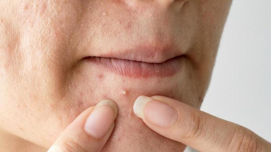 Mujer explota grano en la barbilla