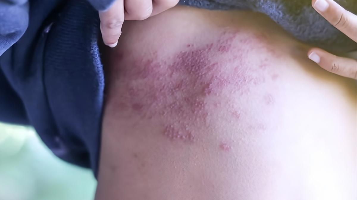 Marcas producidas en la piel por el herpes zóster.