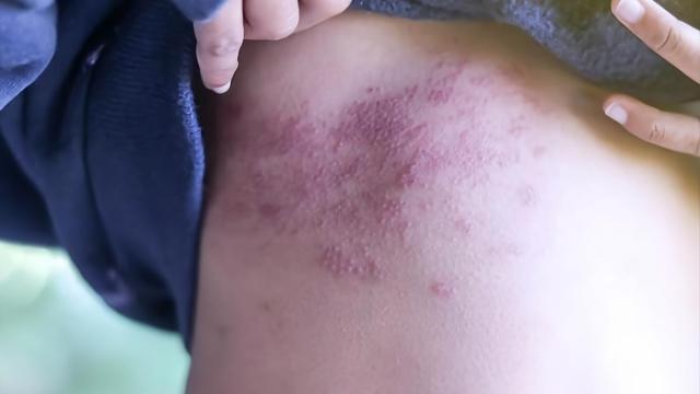 Marcas producidas en la piel por el herpes zóster.