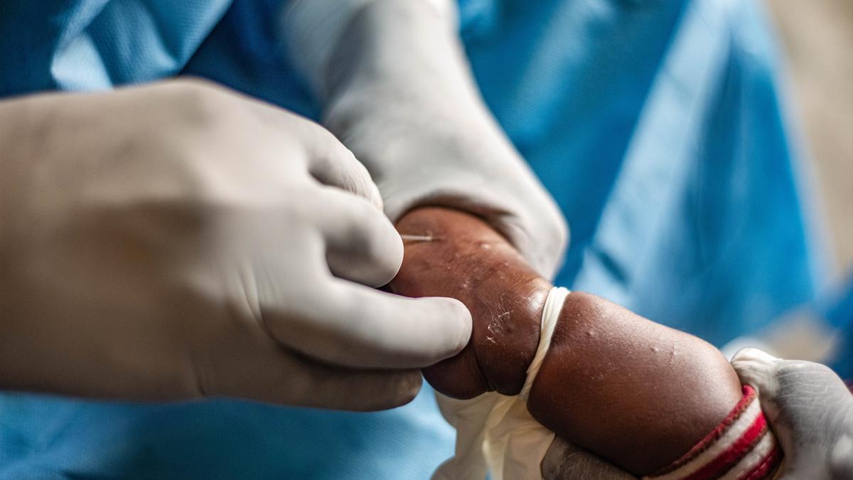 Un niño recibe el tratamiento contra el virus mpox en un centro médico.