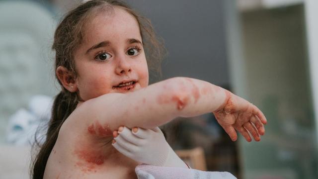 Una niña afectada por la epidermólisis bullosa distrófica, enfermedad popularmente conocida como "piel de mariposa"
