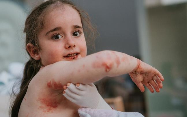 Una niña afectada por la epidermólisis bullosa distrófica, enfermedad popularmente conocida como "piel de mariposa"