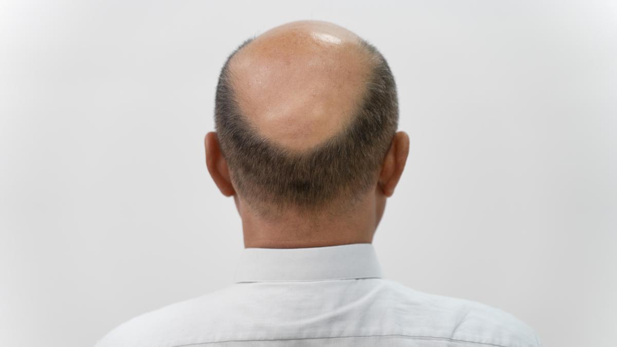 Una calva ajena a esta historia.