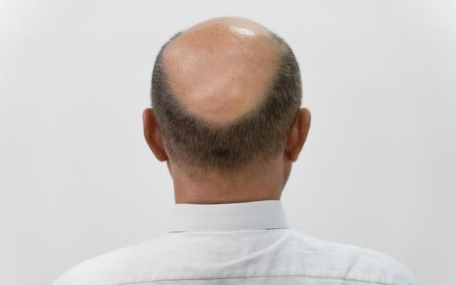 Una calva ajena a esta historia.