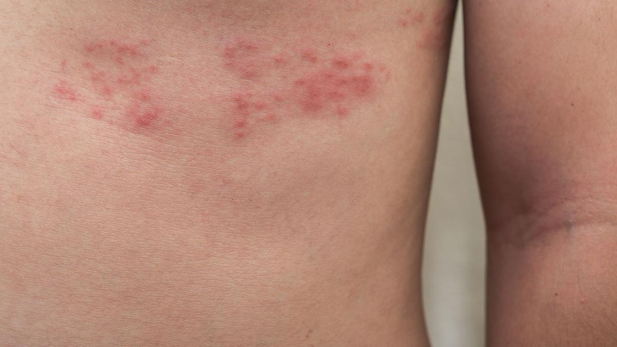 La también conocida como ‘culebrilla’ está causada por el mismo virus que da origen a la varicela.