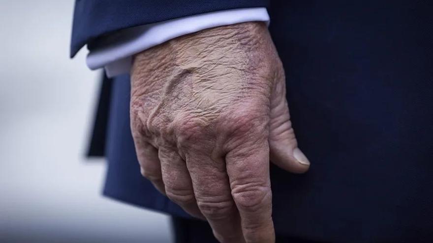 Moretón cubierto de maquillaje en la mano de Donald Trump.