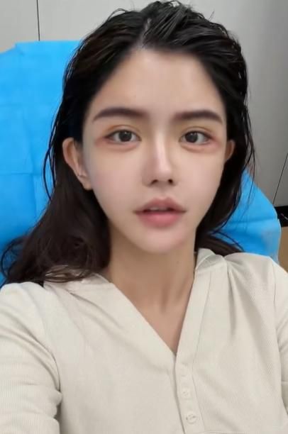 La influencer está ahora deshaciendo sus rellenos y tratando de recuperar su rostro de antaño.