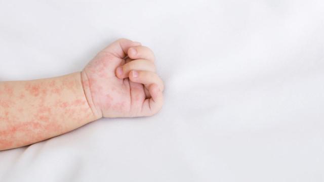 La erupción cutánea típica comienza en la cara y se extiende progresivamente por el resto del cuerpo.