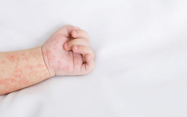 La erupción cutánea típica comienza en la cara y se extiende progresivamente por el resto del cuerpo.