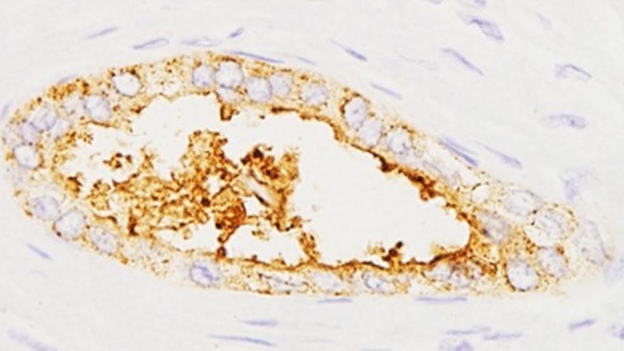 Expresión de la proteína sAXL en tumores pancreáticos.