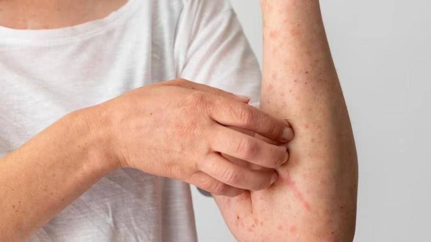 Una persona con dermatitis se rasca