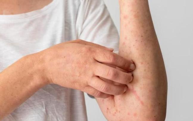 Una persona con dermatitis se rasca Una persona con dermatitis se rasca