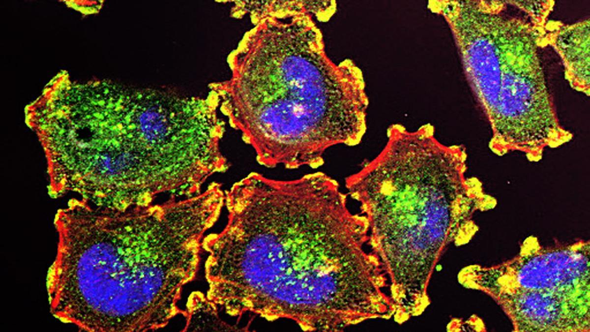 Células metastásicas de melanoma observadas mediante microscopía.