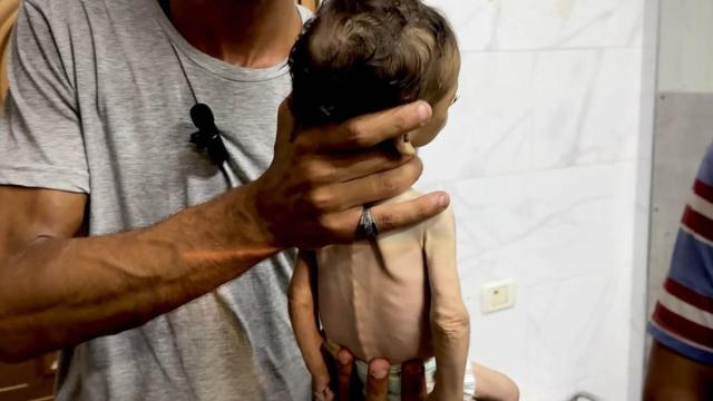 Un hombre sostiene a un bebé con graves síntomas de desnutrición en la Ciudad de Gaza.