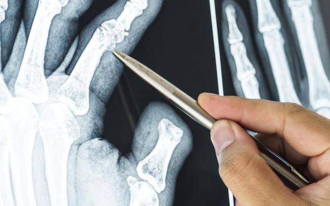 Imagen de recurso de un médico comprobando un hueso fracturado. Imagen de recurso de un médico comprobando un hueso fracturado.
